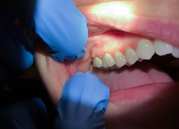 Best Emergency Dentist for Lost Fillings or Crowns in Morris, OK
